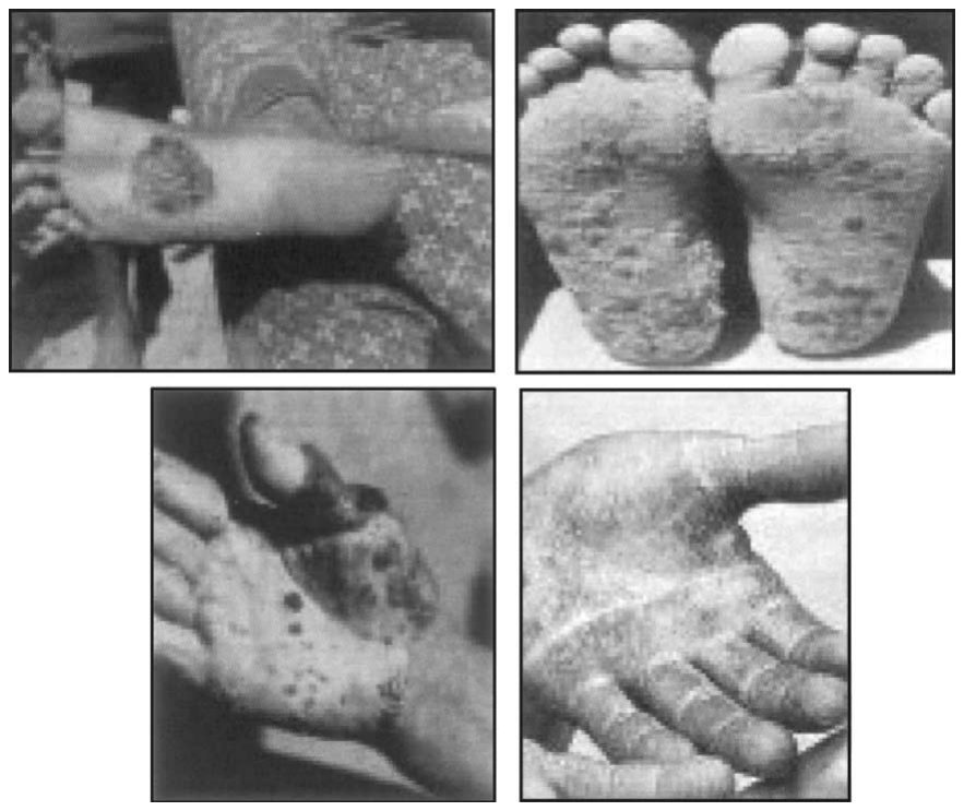 Figure 3 Skin lesions (hyperkeratosis) at various stages due to arsenic poisoning.