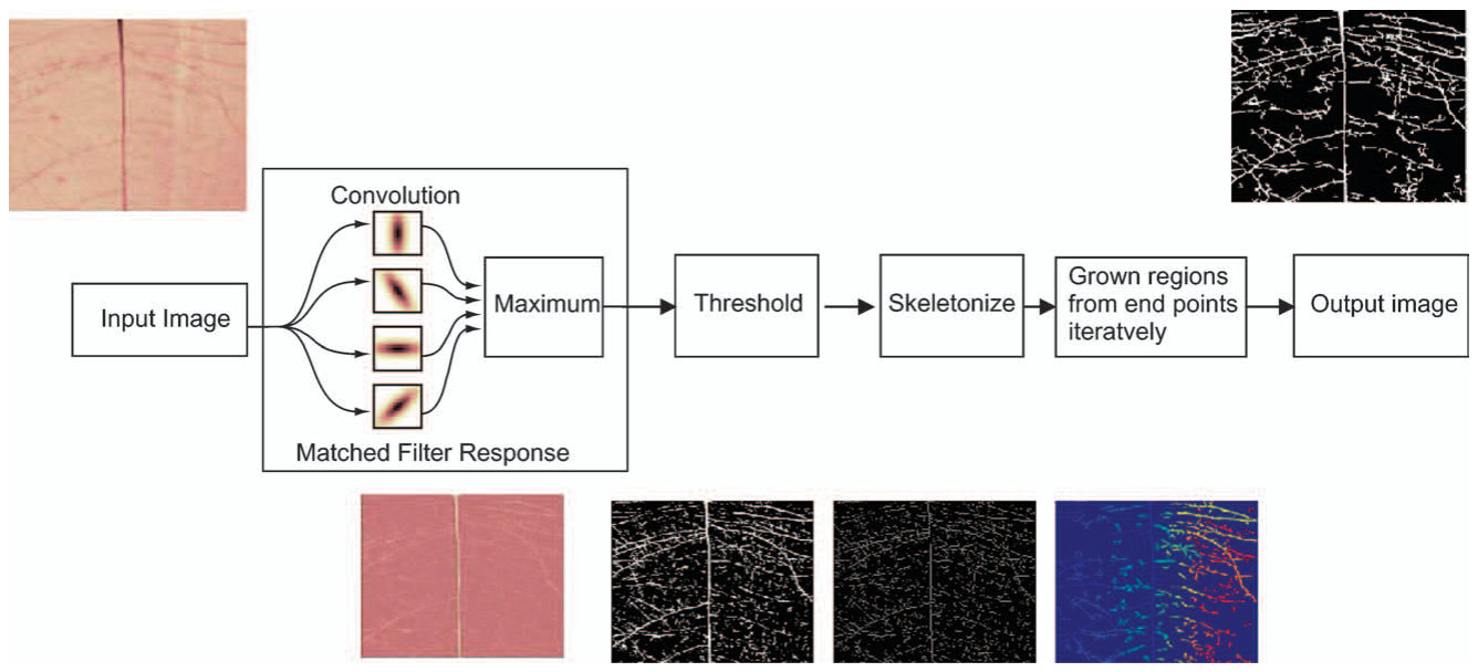 Figure 3 Schematic description of Hoover’s blood vessel segmentation method proposed by Hoover et al. (2000).